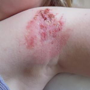 skin condition on upper arm