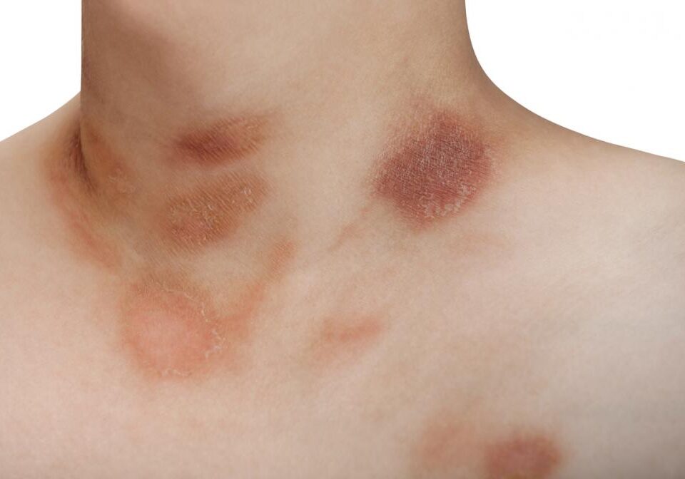 Pityriasis Rosea - Auckland Skin Clinic