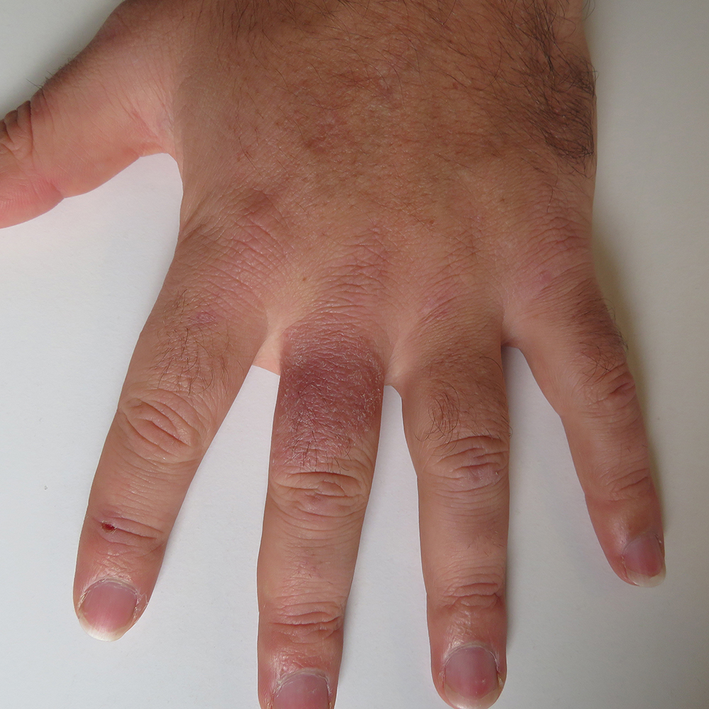 hand with scaly rash