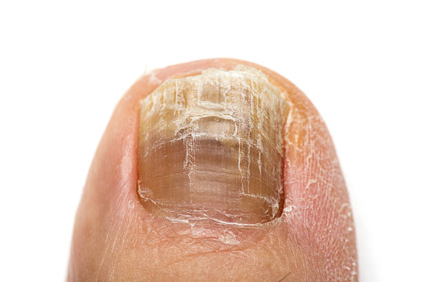 What might be the reason why my fingernail is turning blue? - Quora