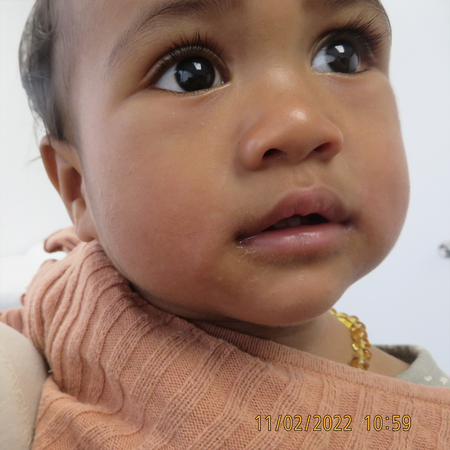 baby with clear skin after treatment