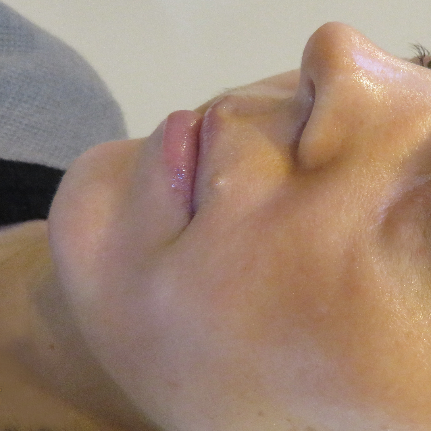 woman with clear skin following treatment