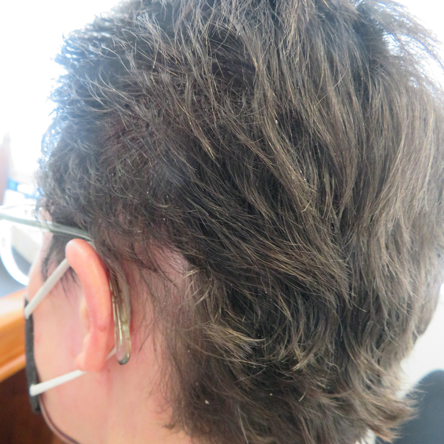 hair regrowth after skin treatment
